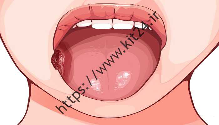 م دهان  علت ، راهکارها و درمان توسط دکتر گوش و حلق و بینی